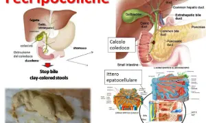Feci ipocoliche, color argilla, dovute a ostruzione biliare. L'immagine mostra un diagramma del sistema biliare e un esempio di feci chiare.