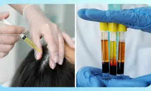 Manos enguantadas aplicando mesoterapia capilar con jeringa y mostrando tubos de ensayo con plasma.