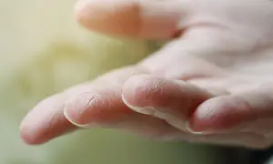 Suchy naskórek na palcach dłoni, schodząca skóra z dłoni.