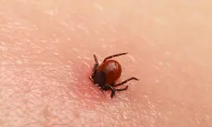 Zbliżenie na wbitego kleszcza na ludzkiej skórze. Pajęczak z ośmioma odnóżami wgryza się w naskórek, widoczny jest zaczerwieniony obszar wokół niego.
