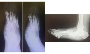 Radiografie del piede con deformità tipica del piede di Charcot, in preparazione per un intervento chirurgico.