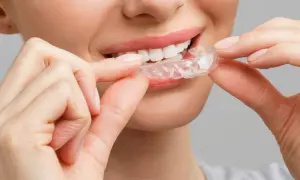 Sorriso smagliante con clear aligners. La donna sorride mentre applica gli apparecchi trasparenti per un sorriso perfetto.