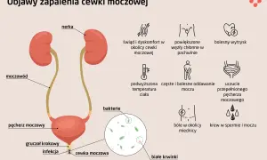 Objawy zapalenia cewki moczowej: dyskomfort, ból, gorączka, krew w moczu, obecność bakterii i białych krwinek.