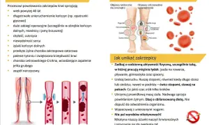 Jak zapobiec zakrzepicy? 4 filary dla zdrowych żył. Sprawdź ryzyko!
