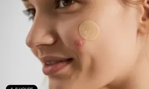Ile trzymać maść ichtiolową na pryszczu? Ekspert radzi!