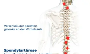 Spondylose mit Radikulopathie: Verschleiß der Facettengelenke an der Wirbelsäule, rot markierte Schmerzpunkte.