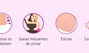 Ilustraciones de molestias comunes en **17 semanas de embarazo**: abdomen, ganas de orinar, estrías y calambres.