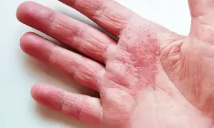 Rote, schuppige Haut an der Handfläche und den Fingern, Anzeichen von atopischem Ekzem. Gute Hautpflege ist wichtig.