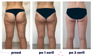 Przed i po kriolipolizie ud. Widoczne zmniejszenie cellulitu i poprawa jędrności skóry po 1 i 2 seriach zabiegu.