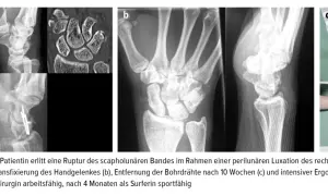 Röntgenbilder zeigen das distale Handgelenk vor und nach einer Operation.
Die Patientin ist nach 3 Monaten wieder arbeitsfähig.