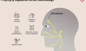 Ilustracja przedstawia przyczyny zapalenia nerwu twarzowego: wirusy, nowotwory, problemy stomatologiczne, zaburzenia naczyń mózgowych i zapalenie mięśni.