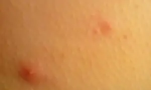 Widoczne czerwone krosty na pośladkach, niektóre z białymi czubkami, świadczą o podrażnieniu skóry.