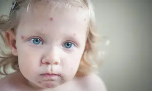 Mała dziewczynka z niebieskimi oczami, na jej twarzy widać czerwone kropki, objawy ospy. Dzień po dniu choroba postępuje.