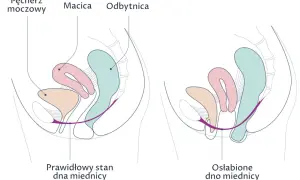 Porównanie prawidłowego i osłabionego dna miednicy. Na drugim obrazku widać obniżenie narządów, co może prowadzić do wypadania pochwy.