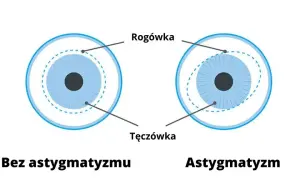 Astygmatyzm: Czy okulary są konieczne? Sprawdź, od czego zależy