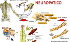 Il dolore neuropatico è illustrato con schemi di nervi, vasi sanguigni e muscoli, mostrando i danni da neuropatia diabetica.