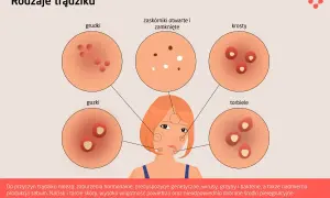 Ilustracja przedstawia różne rodzaje trądziku: grudki, zaskórniki, krosty, guzki i torbiele, ukazując ich wygląd.