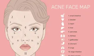 Mappa del viso per l'acne: i brufoli sulla mandibola (zona 9) potrebbero indicare problemi intestinali.