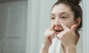 Ragazza si lava il viso, concentrandosi sui brufoli sul naso con schiuma detergente.