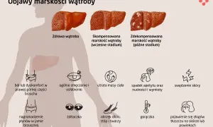 Objawy marskości wątroby: ból brzucha, zmęczenie, utrata masy ciała, żółtaczka, obrzęki, gorączka, swędzenie skóry, złogi tłuszczu. Wzw b może prowadzić do marskości.