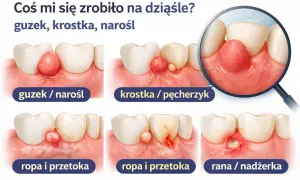 Ilustracja pokazuje różne stadia ropnia na dziąśle: guzek, krostkę, ropę i ranę.