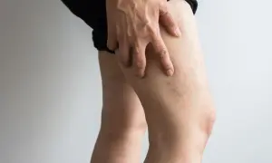 Dłoń dotyka uda, na którym widoczne są pajęczaki i drobne żylaki na nodze.