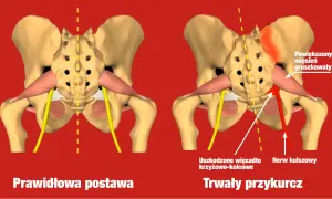 Powiększony mięsień gruszkowaty uciska nerw kulszowy, powodując trwały przykurcz.
