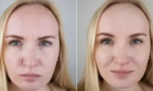 Przed i po mezoterapii igłowej: wygładzone zmarszczki na czole, poprawa jakości skóry. Mezoterapia igłowa efekty po 1 zabiegu widoczne od razu.