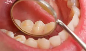 Widok jamy ustnej z lusterkiem dentystycznym. Widoczne zęby z przebarwieniami, które mogą świadczyć o tym, jak szybko rozwija się próchnica.