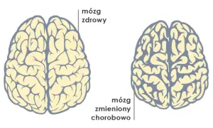 Demencja to nie choroba psychiczna? Poznaj kluczowe różnice