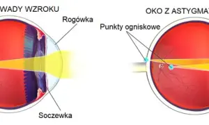 Astygmatyzm u dorosłych: Czy ustępuje? Poznaj metody korekcji
