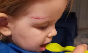 Dziecko z raną na czole je z żółtej łyżeczki. Zastanawiamy się, ile czasu po uderzeniu w głowę dziecko nie może spać.