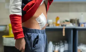 Dziecko z opatrunkiem na brzuchu po operacji.