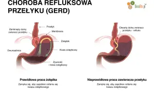 Dieta na refluks: Skuteczne zasady i jadłospis dla Twojej ulgi