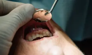 Dentysta bada jamę ustną, szukając oznak ropień zęba powikłania. Widoczne są zęby i błona śluzowa.