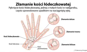 Ilustracja anatomiczna dłoni z zaznaczonymi złamaniami kości łódeczkowatej.