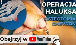 Znieczulenie do operacji haluksa: wybierz najlepszą metodę dla siebie!