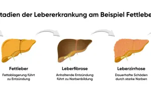 Verlauf einer Lebererkrankung: gesunde Leber, Fettleber, Leberfibrose, Leberzirrhose und Leberkrebs. Stres oksydacyjny kann diese Entwicklung beschleunigen.