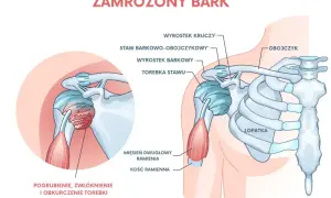 Ilustracja przedstawia zamrożony bark, z zaznaczonym pogrubieniem i zwłóknieniem torebki stawu, co powoduje ból barku.
