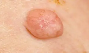 Kłykciny kończyste: do dermatologa, urologa czy ginekologa?