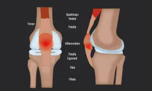 Entzündung der Patella Sehne am Kniegelenk, mit Femur, Patella und Tibia.