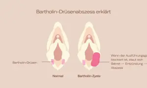 Vergleich von normaler Bartholin-Drüse und Bartholin-Zyste/Abszess im Intimbereich. Zeigt, wie Sekretstau zu Entzündung und Abszess führt.