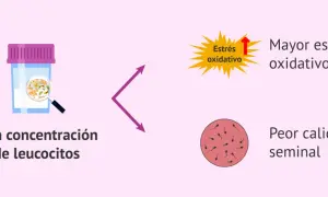 Recipiente con alta concentración de leucocitos, que indica mayor estrés oxidativo y peor calidad seminal.