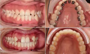 Denti con agenesia dentale, alcuni con apparecchio ortodontico per correggere gli spazi vuoti.