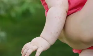 Rączka dziecka w różowej bluzeczce z czerwonymi kropkami, które mogą być objawem odry. Choroba ta wymaga konsultacji lekarskiej.