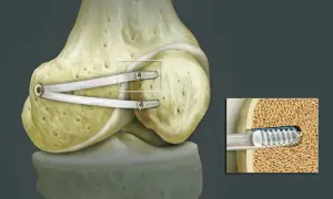 Knochen mit MPFL-Plastik-Implantat zur Stabilisierung der Kniescheibe. Detailansicht zeigt Schraube im Knochen.