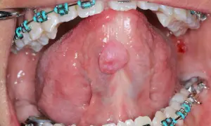 Lingua con apparecchio ortodontico e una piccola ranula, una lesione benigna.