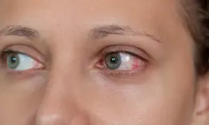 Czerwone, podrażnione oko, objaw zespołu suchego oka. Poszukuje się skutecznego leczenia.