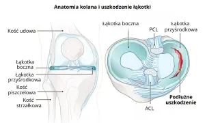 Ilustracja anatomii kolana z zaznaczonymi elementami, w tym uszkodzoną łąkotką przyśrodkową.