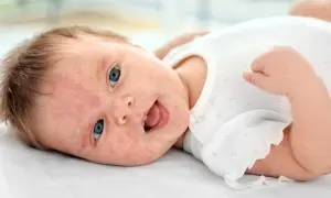 Söt bebis med blå ögon och lite babyakne på kinderna, glad och skrattande.